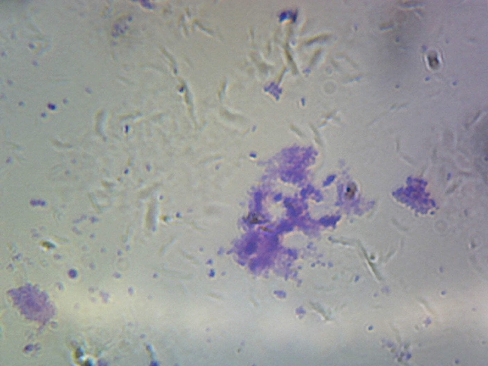 Streptococcus Pneumoniae (Diplococcus); Smear; Gram-Positive