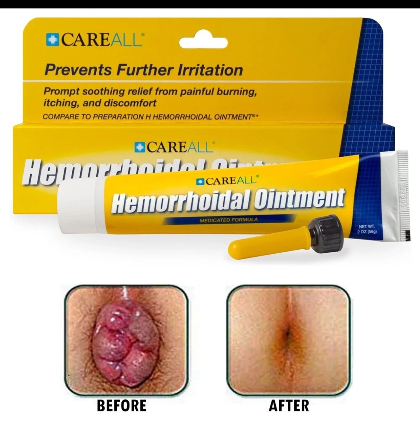 NEW Antiinflamatorio para desinflamar las hemorrodides y evitar las molestias