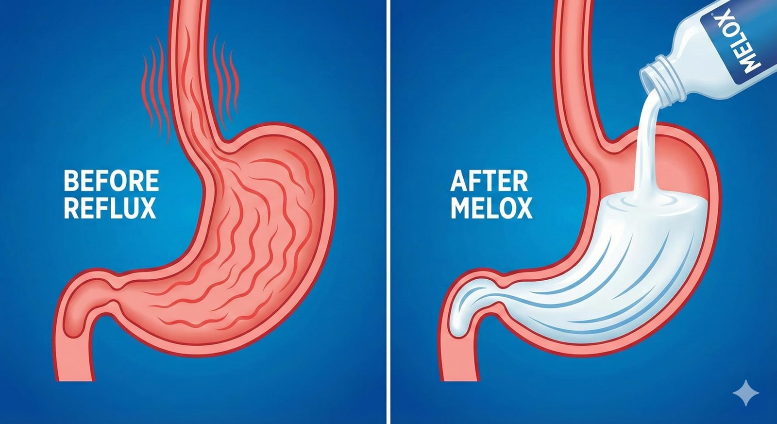 Melox for Heartburn Relief