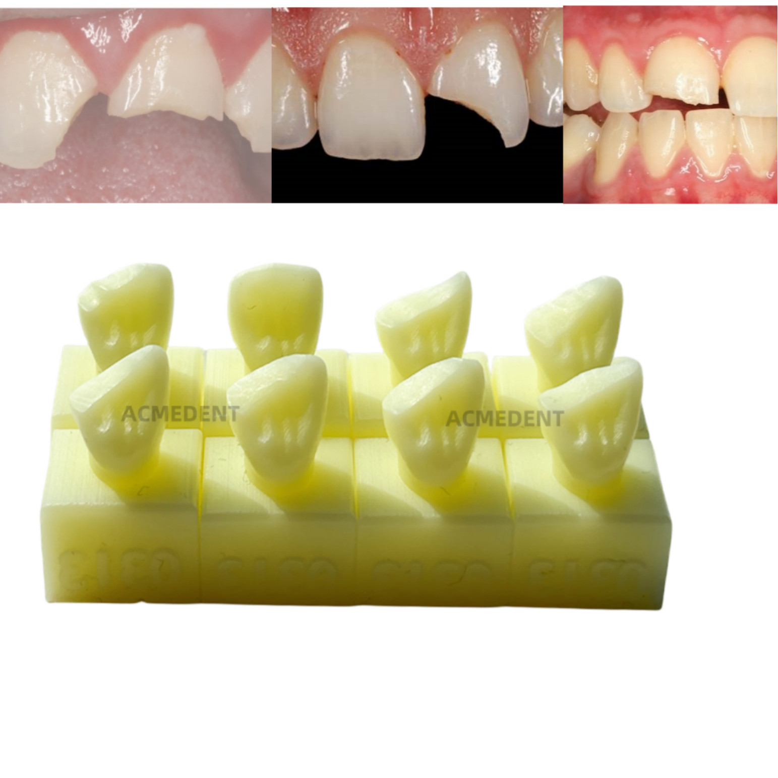 10Set Dental Front Teeth Composite Restore Fractured Chipped Tooth Cracked Model