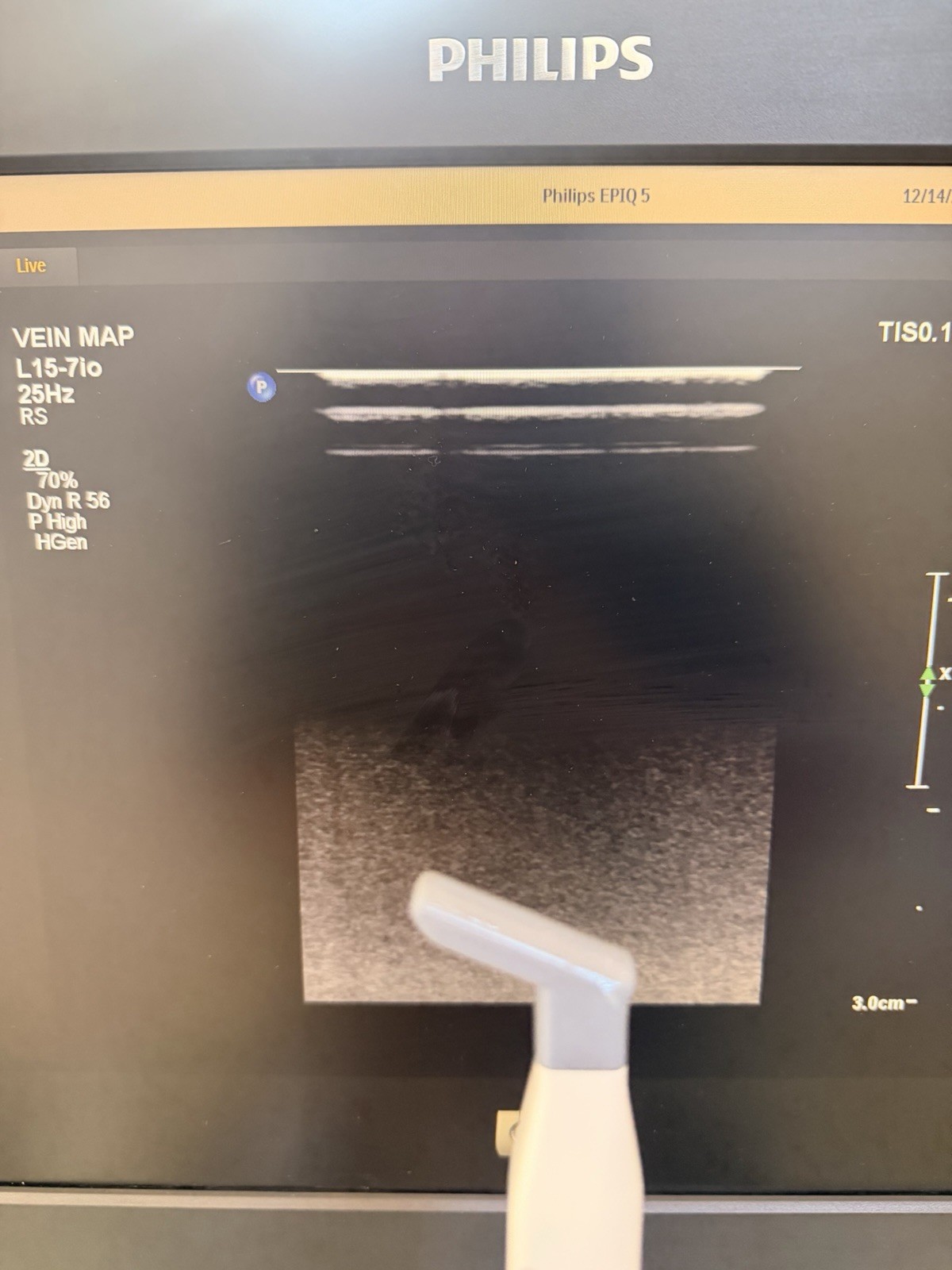 Philips L15-7io Hockey Stick Ultrasound Probe for Epiq 5/7,CX50 & Sparq (NX5G)