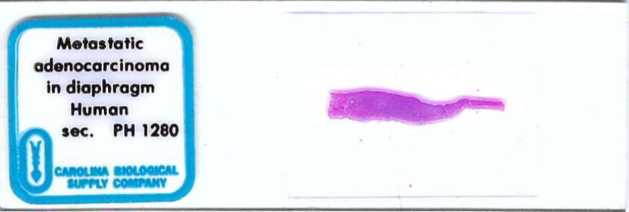 Human Metastatic Adenocarcinoma of Diaphragm Pathology Microscope Slide