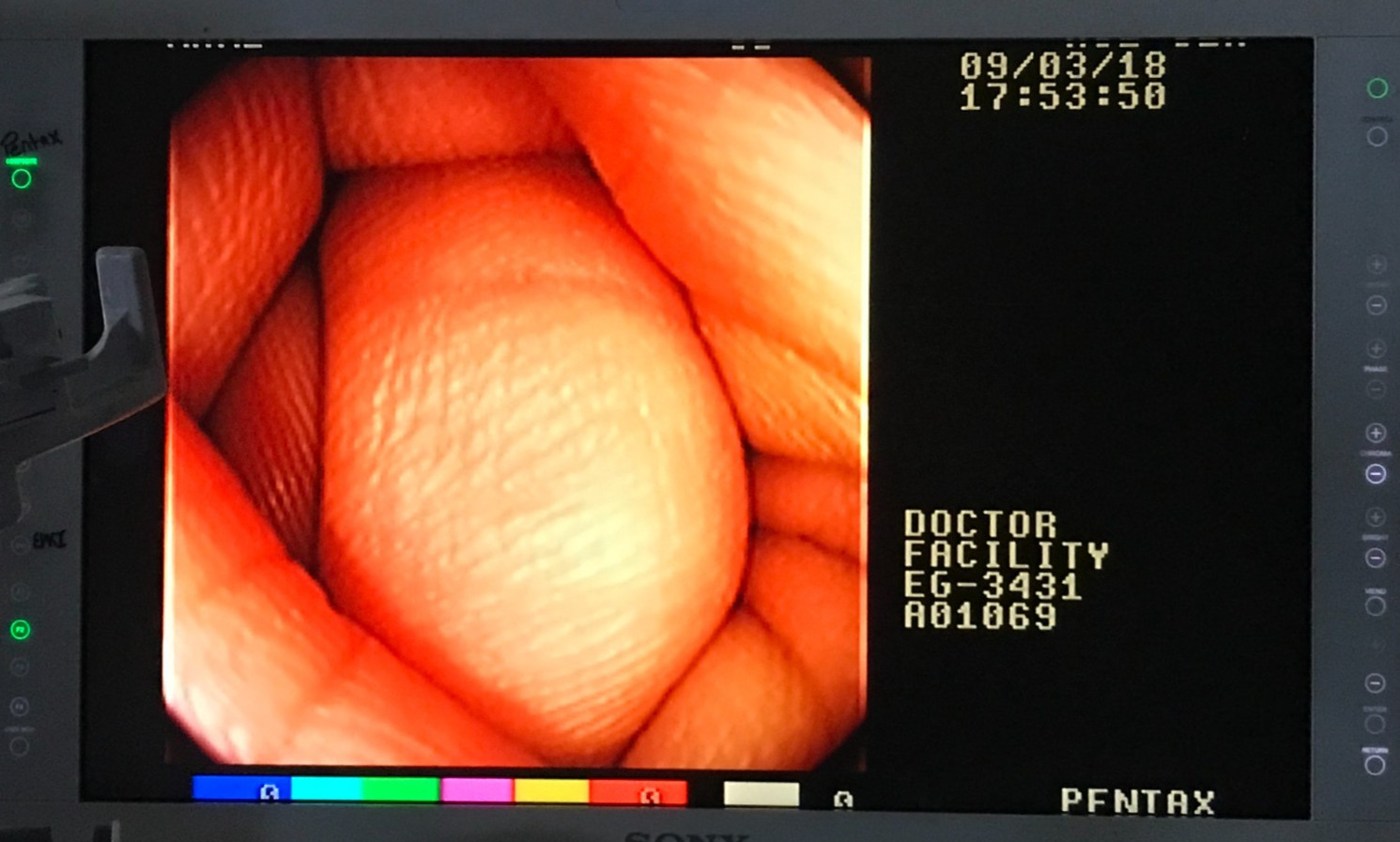Pentax EG-3431 Gastroscope Endoscope Endoscopy (4311-s9)