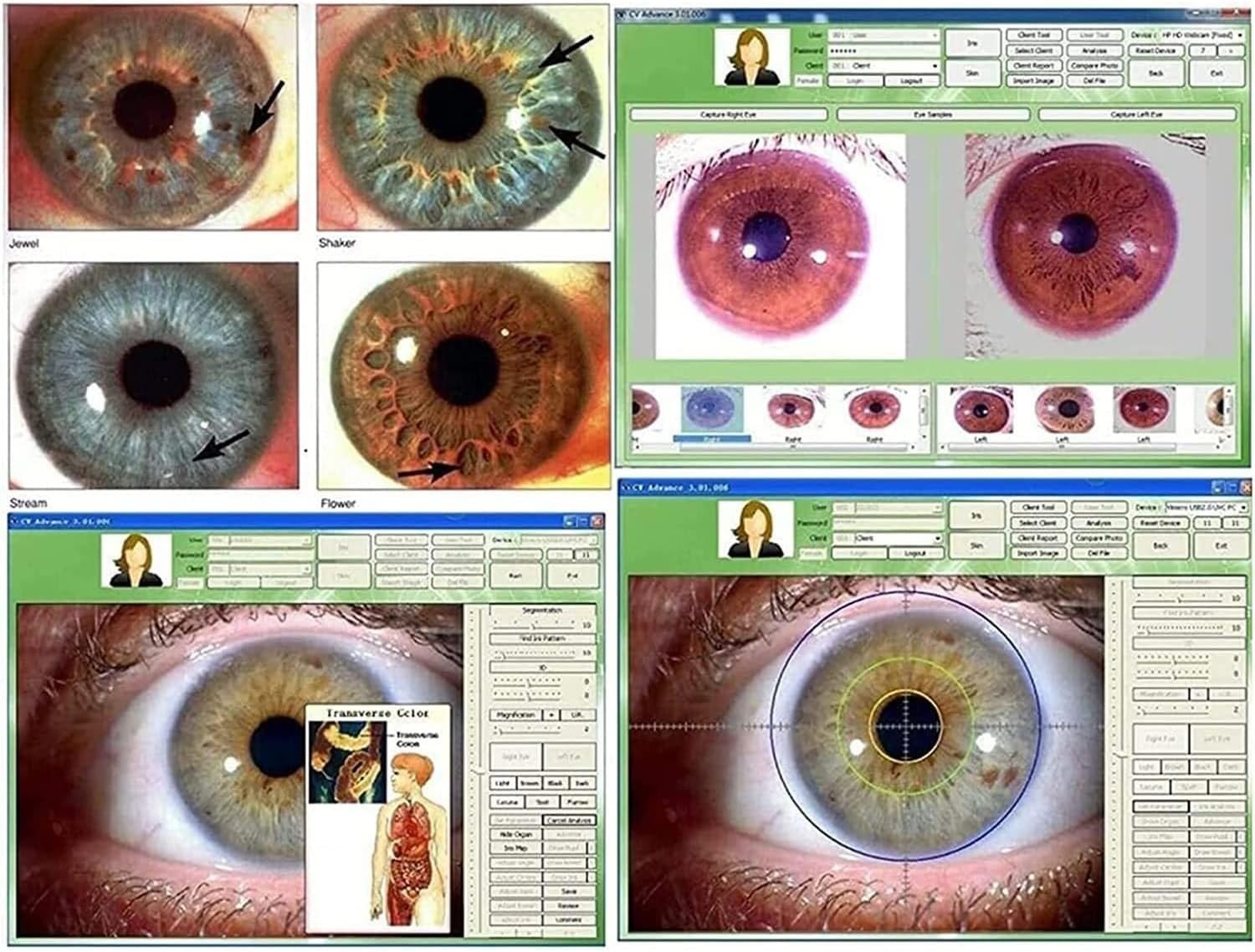 5.0MP USB Iris Analyzer Iridology Camera, 30x Iris Analysis Camera Analyzer Tool