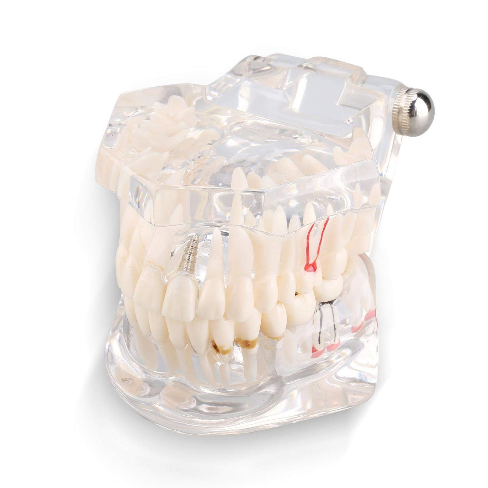 Jeanoko Transparent Tooth Model Dental Implant Disease Teeth Model Adult Typodon