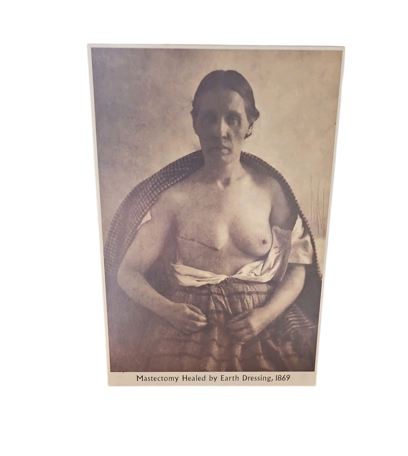 Burns Archive Medical Print, "Mastectomy Healed by Earth Dressing" 1869 Historic