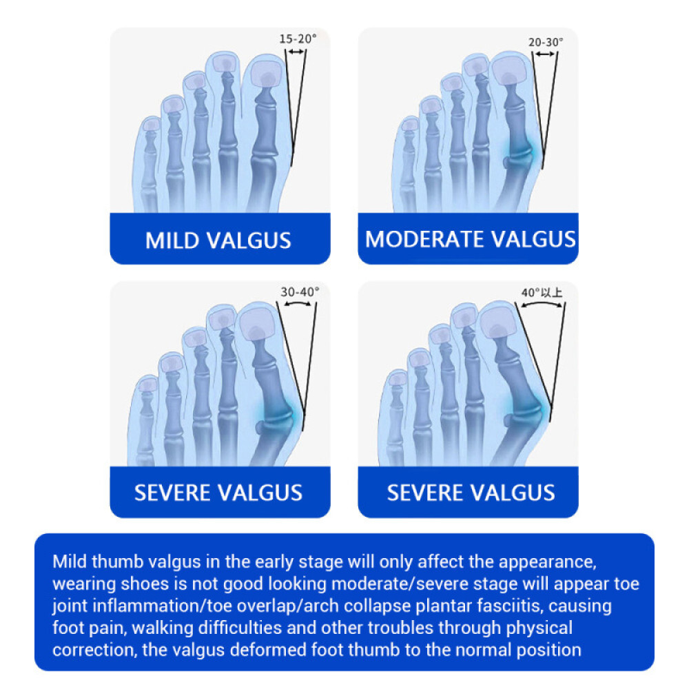 Bunion Fix Toe Valgus Corrector Adjustable Orthopedic Splints for Left and Right
