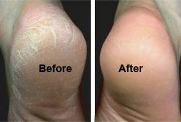 Welpida Solemates - Cracked Heel Healers