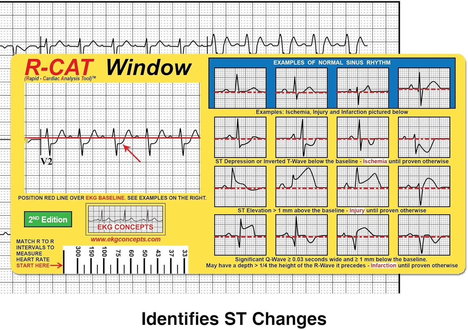 EKG Window 2Nd Edition
