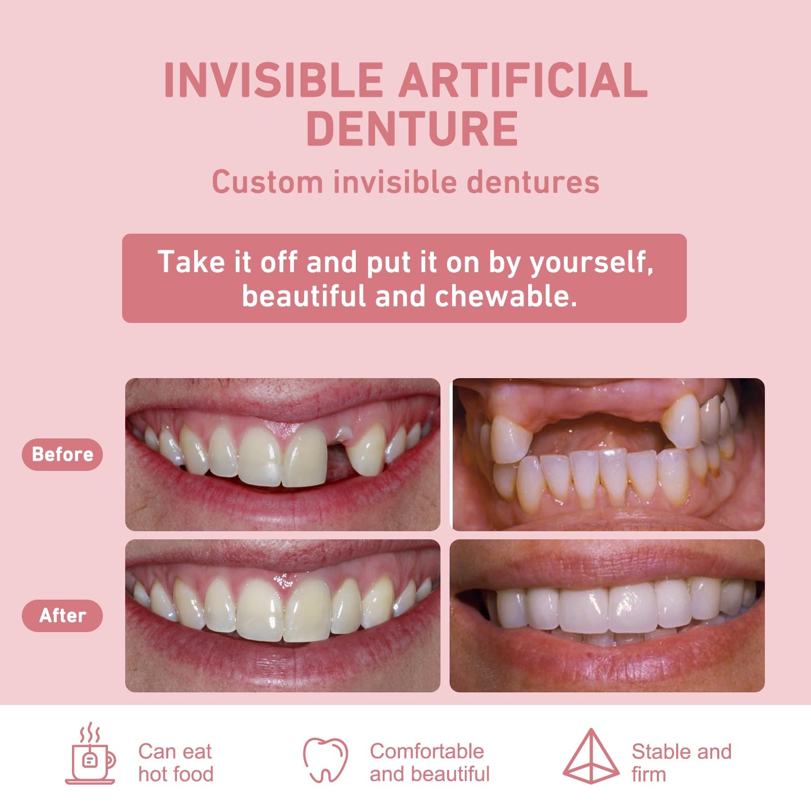 Custom Partial Dentures – Personalized Removable Denture Set for Missing Teet...