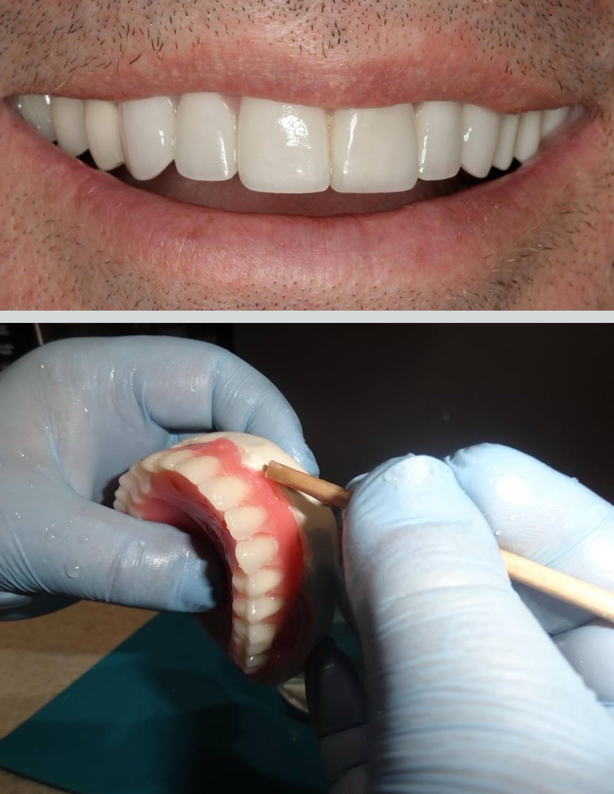 DIY DENTURE KIT Complete Custom Dentures Temporary Teeth Tooth * FULL /PARTIAL*