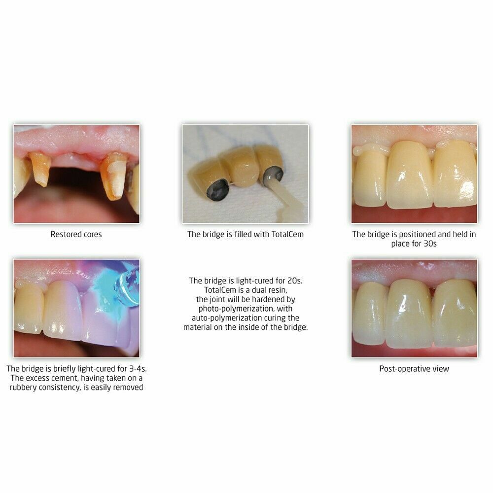 Dengen Rmgi Self Etch, Self Adhesive Resin Cement Dental Free Shipping