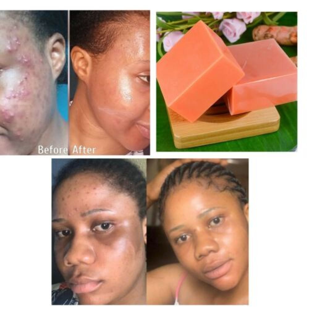 2Pc Turmeric Soap for Face&Body,Skin Brightening Anti-Acne Dark Spots Lightening