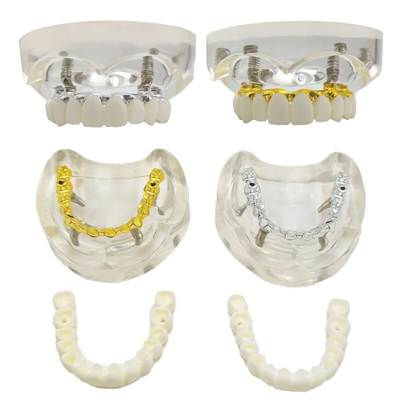 Dental Implant Teeth Model Overdenture Restoration Upper Jaw Teeth Demo Model