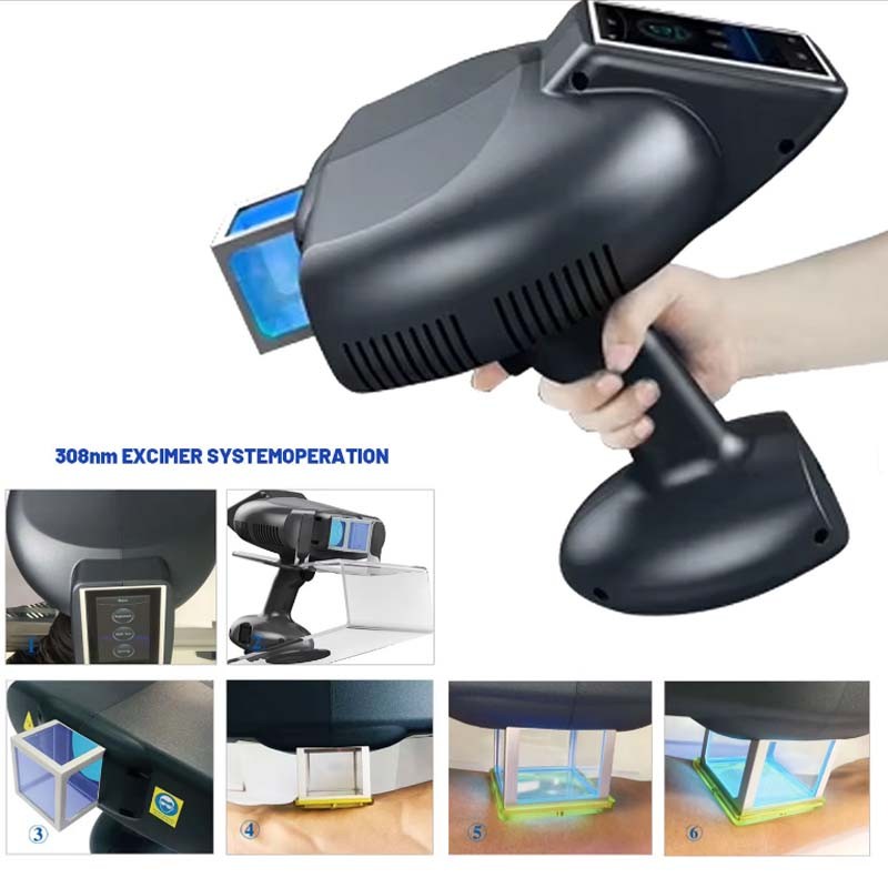 308nm Excimer Laser Phototherapy Light Therapy Dermatological Treatment ﻿