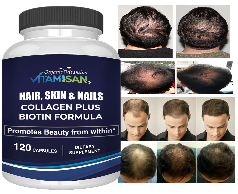 Hair Gain Biotin Hydrolyzed DHT Blocker Hair Growth Vitamins 2500000  Women Men