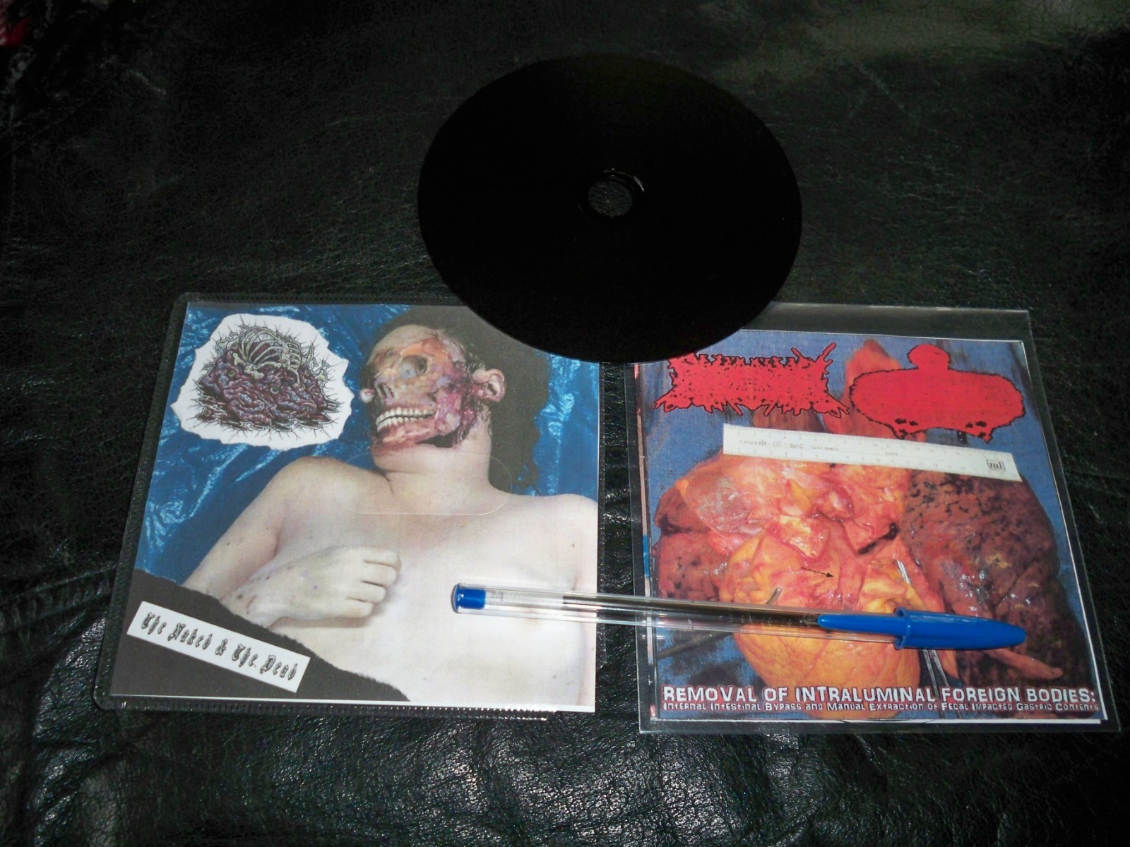 CDr LOT: AMEBIASIS / UxTxIxFxSxPxCx +2026 BOTCHED ANASTOMOSIS J-POUCH Naked&Dead
