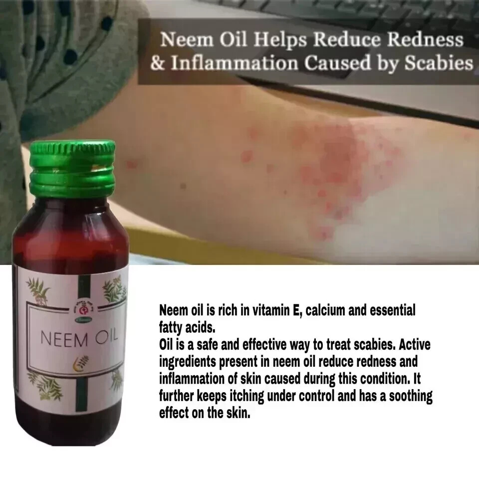 Anti Scabies Kills Scabies Mites And Eggs Complete Eradication Oil 1 Bottle Pack