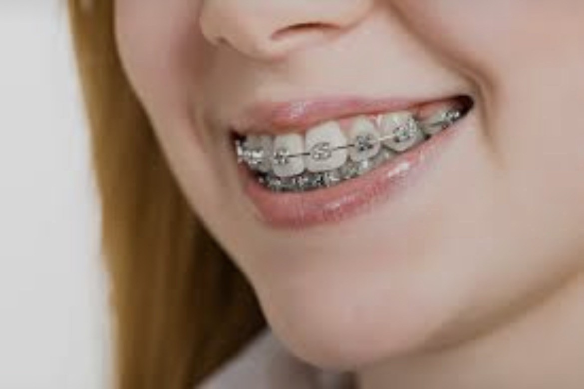 3pieces- metal retainers for teeth