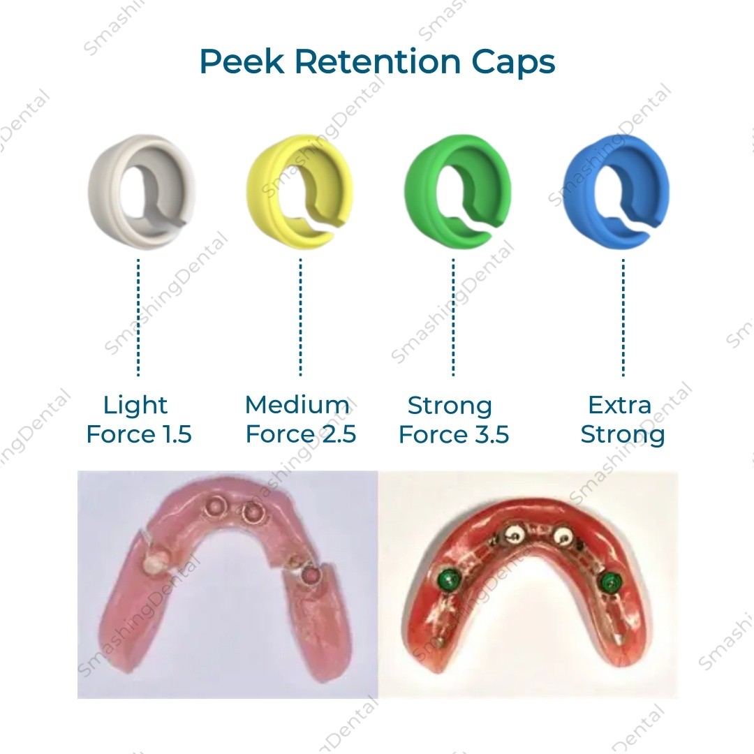Peek Retention Insert Caps Novaloc Type Dental Matrix Ti Housing Caps Mount