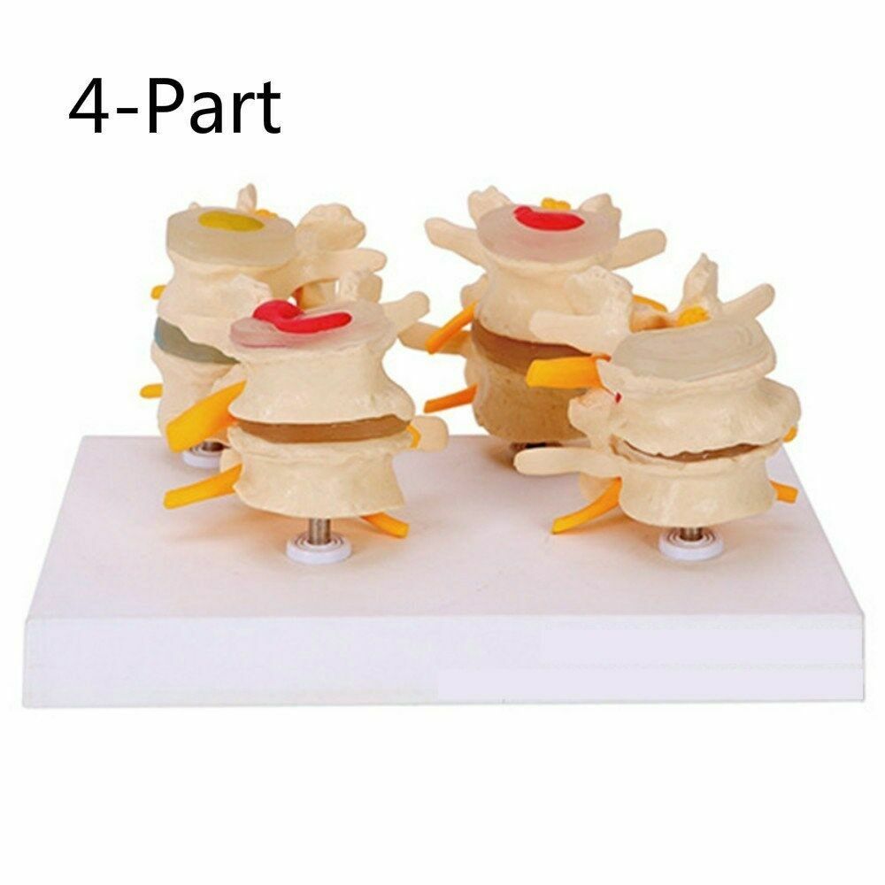 Human Pathology Lumbar Vertebrae Spine Model Normal and Pathological 4 Stages US