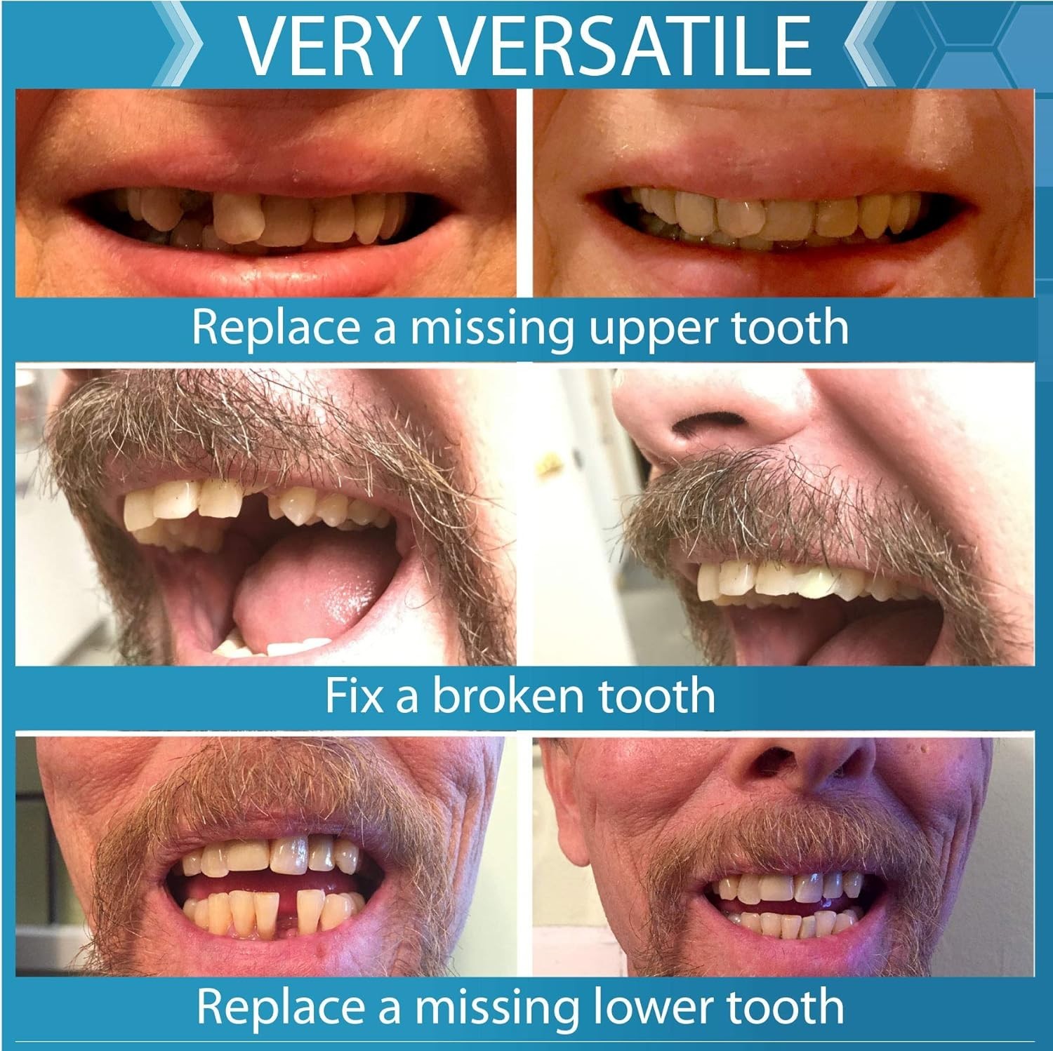 Smile with Confidence: Temporary Tooth Replacement Kit