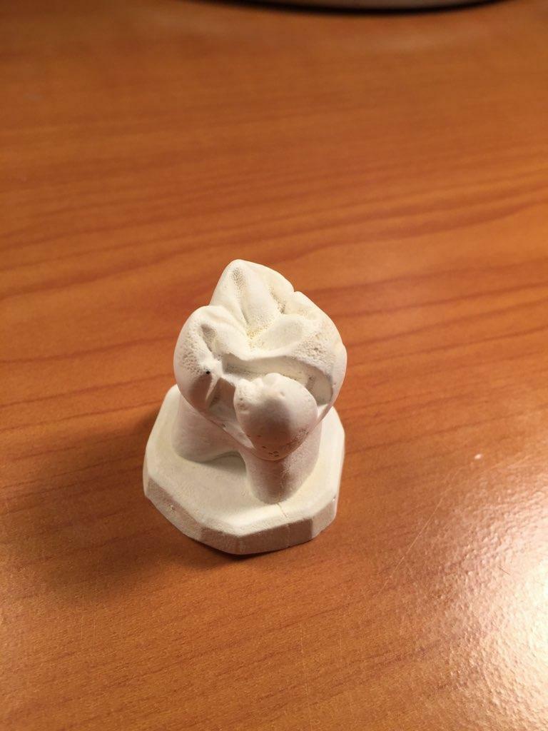 EDUCATIONAL AID - TOOTH MODEL OF DENTAL RESTORATIONS OF CARIES CLASS I, II AND V
