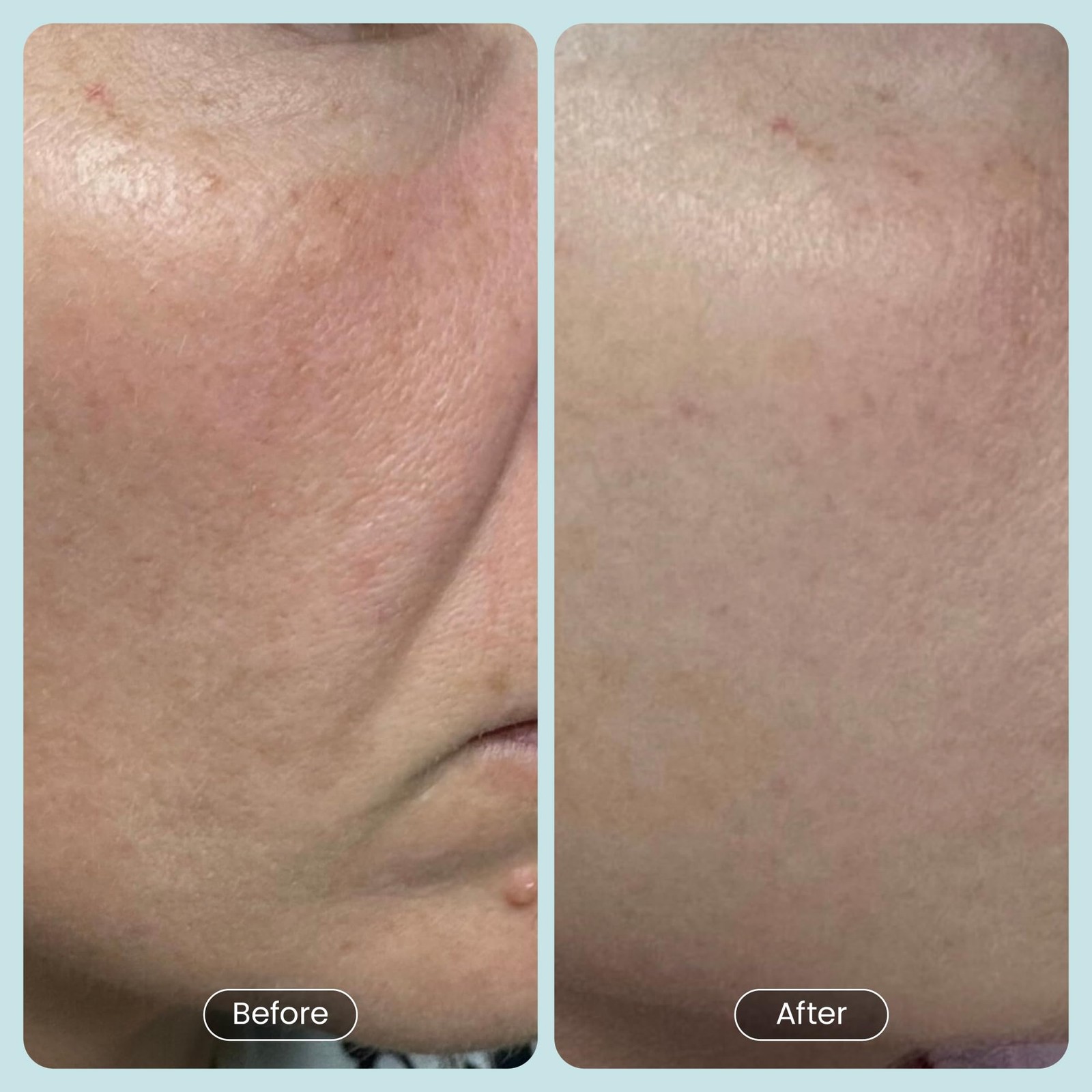 30 DAY MIRACLE BHA 20% Peeling Solution - Clinical Strength BHA Liquid Exfoli...