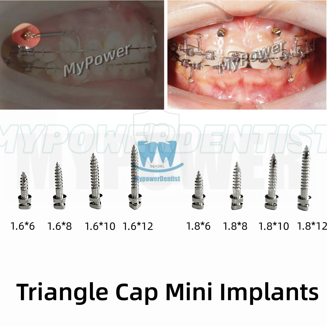 Dental TAS Mini Micro Screw Orthodontic Anchorage Screws Handle Driver Implants