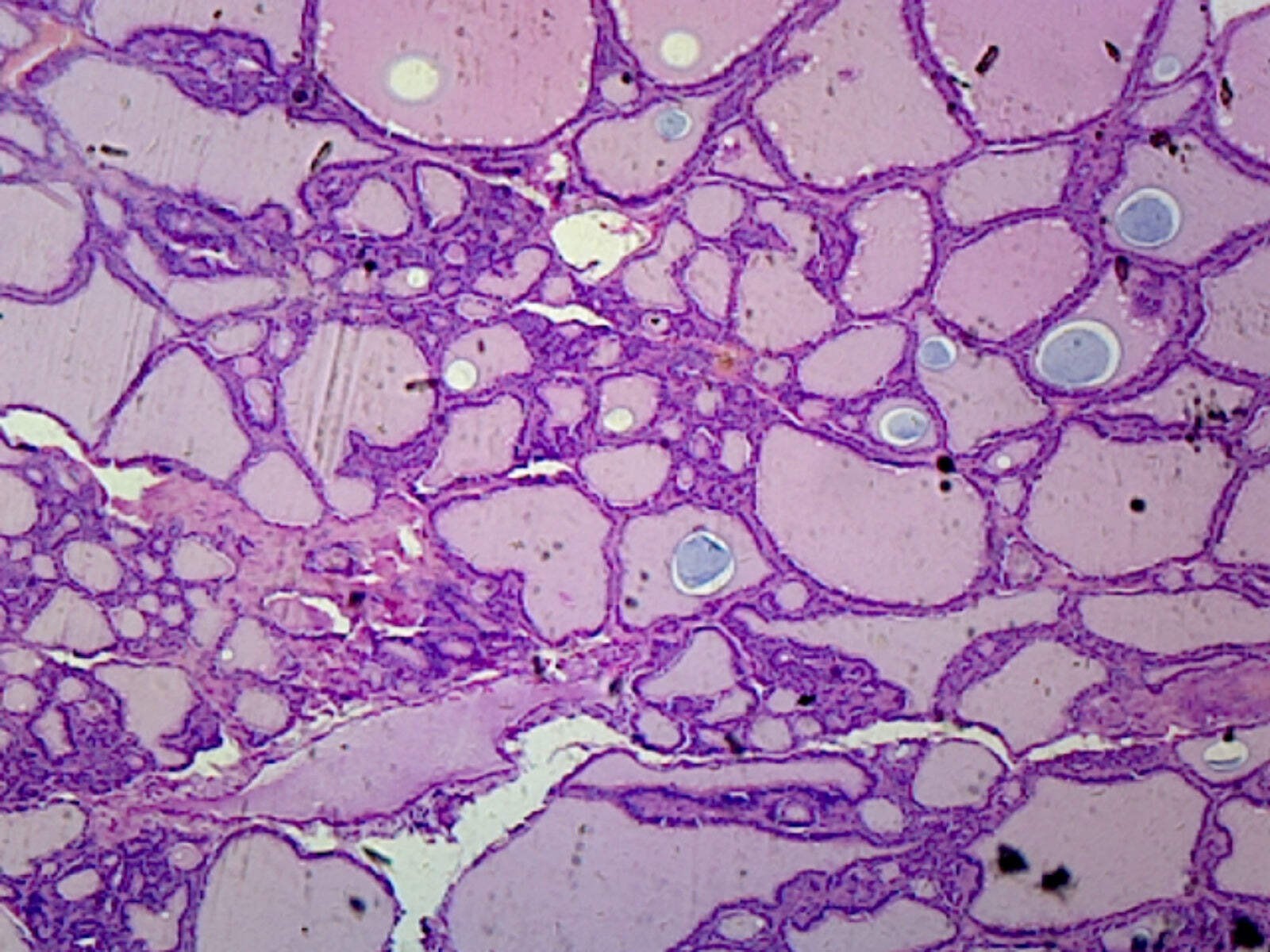 Goiter (Human Endocrine System); Section; H&E Stain