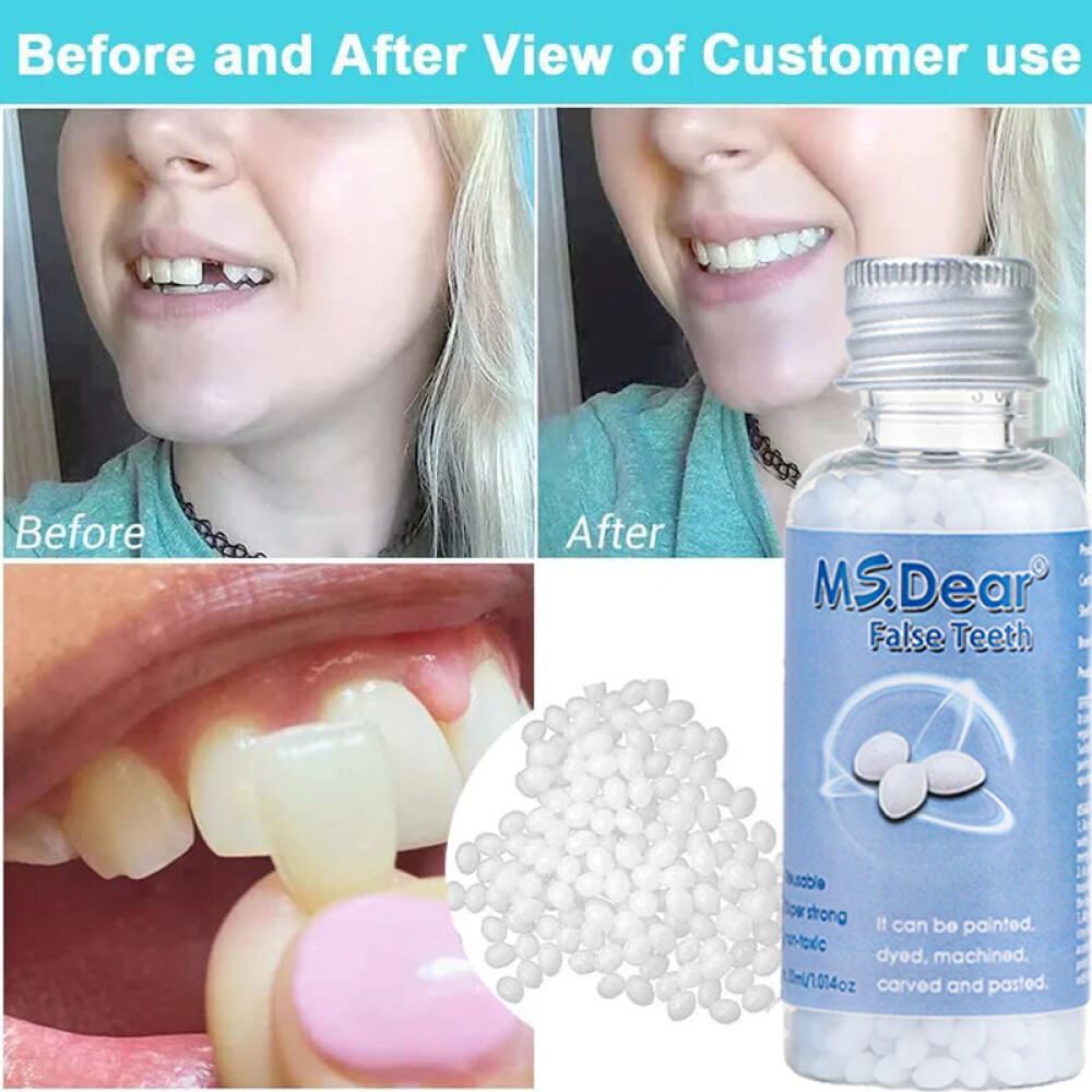 3X Tooth Repair Kit - Temporary Teeth Replacement Kit for Missing & Broken Teeth