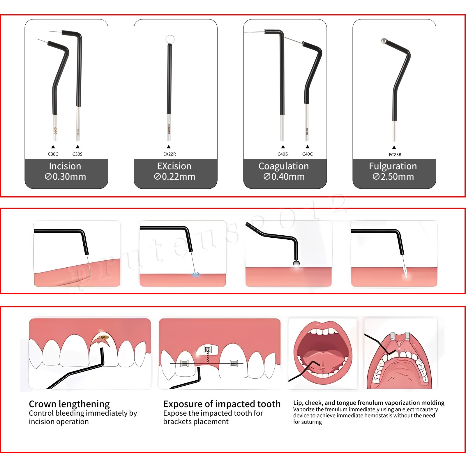 7 x ES20 Electrosurgery Electrode Tips