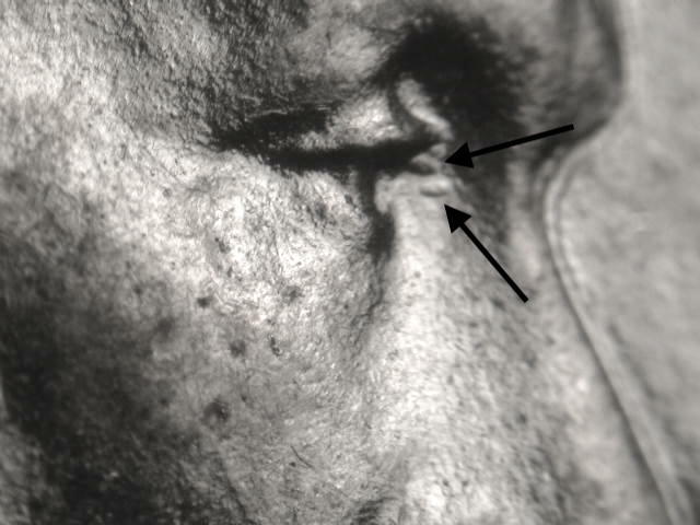 1943-D WDDO-023 Tripled Eyelid Doublled Die Obv. BU Uncirculated Lincoln Cent