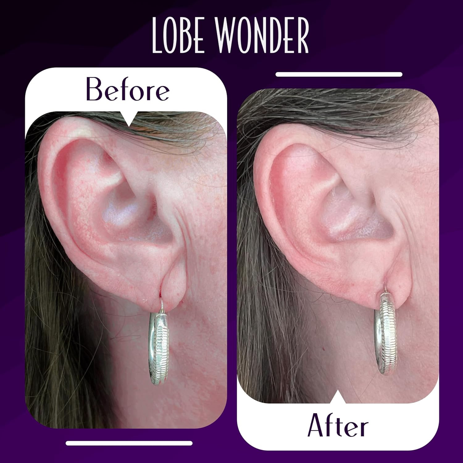 - the ORIGINAL Ear Lobe Support Patch for Pierced Ears - Eliminates the Look ...