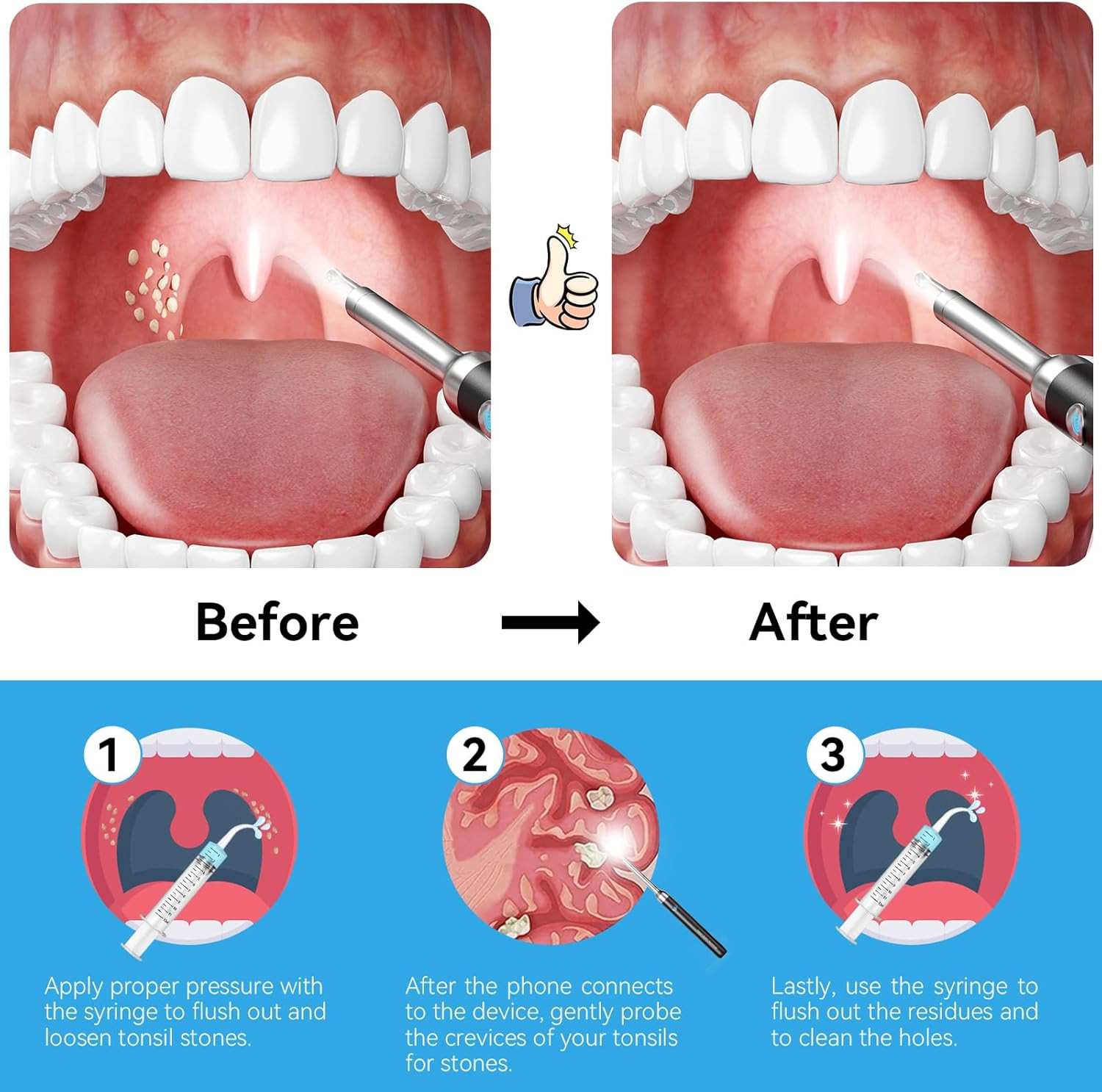 2025 Upgraded Tonsil Stone Remover with Camera, Visual Tonsil Stone Removal Kit