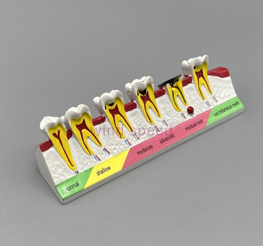 New Dental Study Teaching Models Caries Disease Assort Teeth Dentoform Model