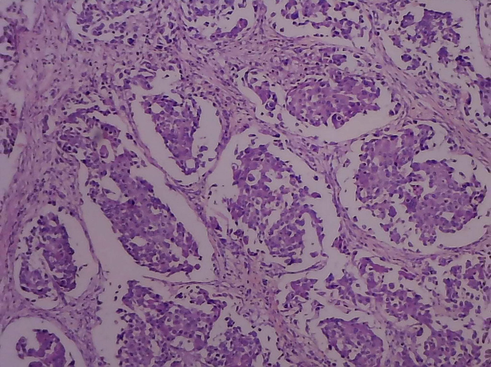 Prepared Slide, Adenocarcinoma of the Breast