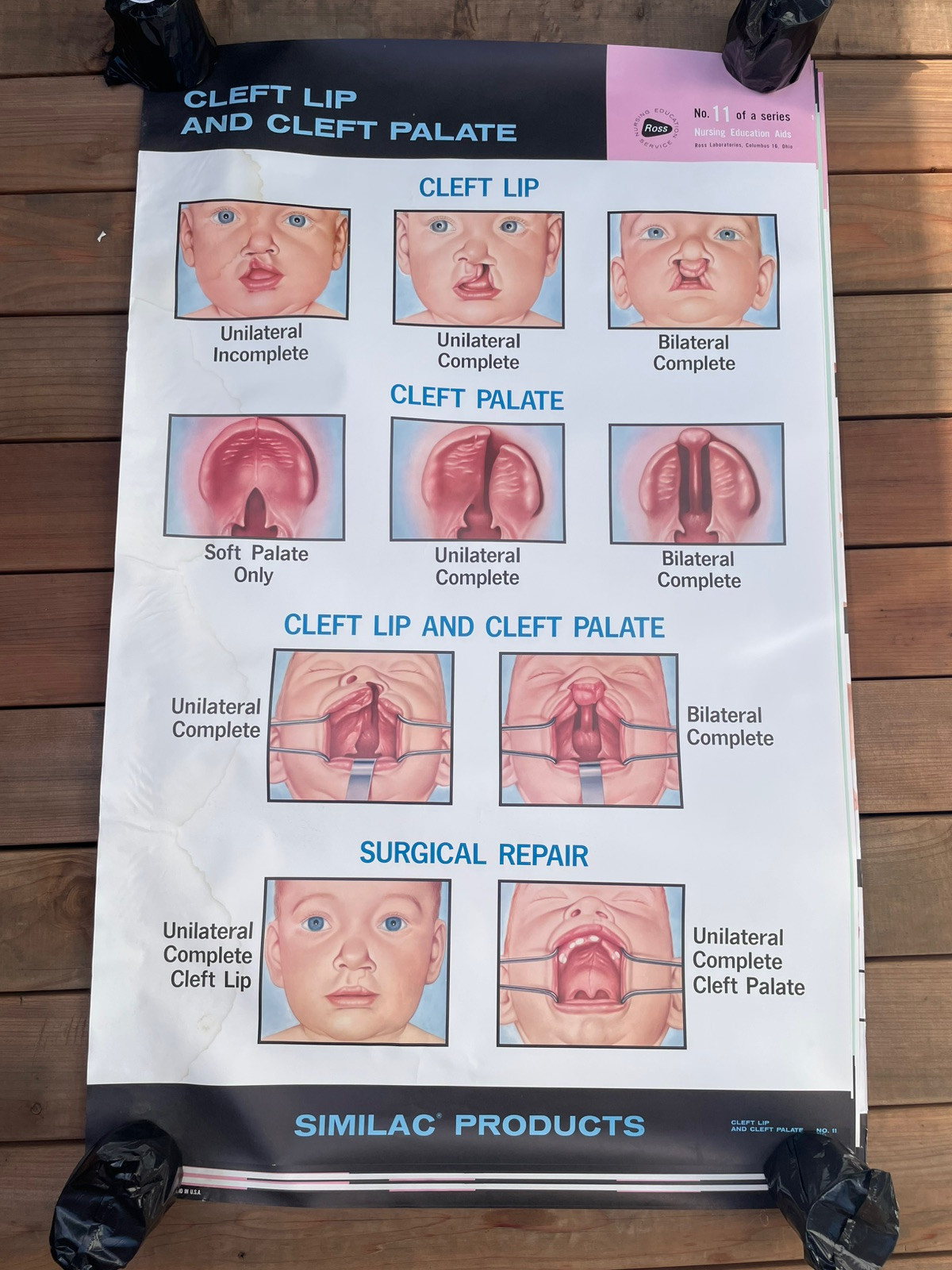 VINTAGE 1962 SIMILAC NURSING POSTER CLEFT LIP PALATE ROSS LABORATORIES