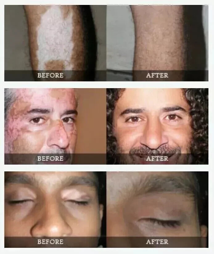 Vitiligo Organics for White Spots Skin Repair RePigmentation Repacked - 30 ml X2