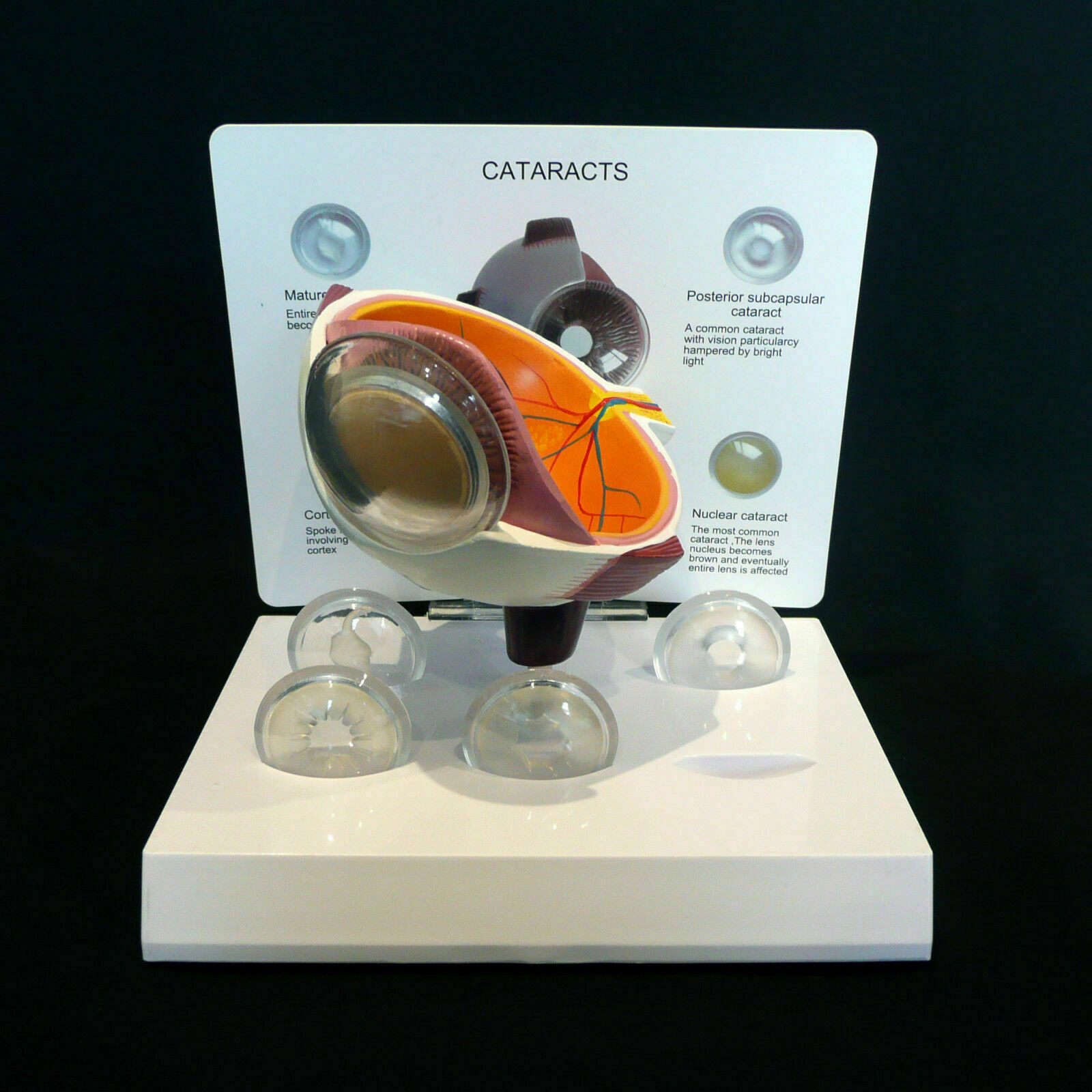 Anatomical Model of Human Cataract and Eye Disease Medical Pathology Anatomy D