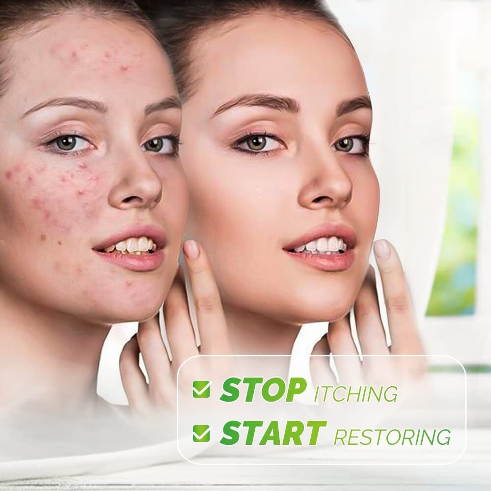 Crema Para Dermatitis Eczema Psoriasis Para Comezon Picazon Ronchas En La Piel