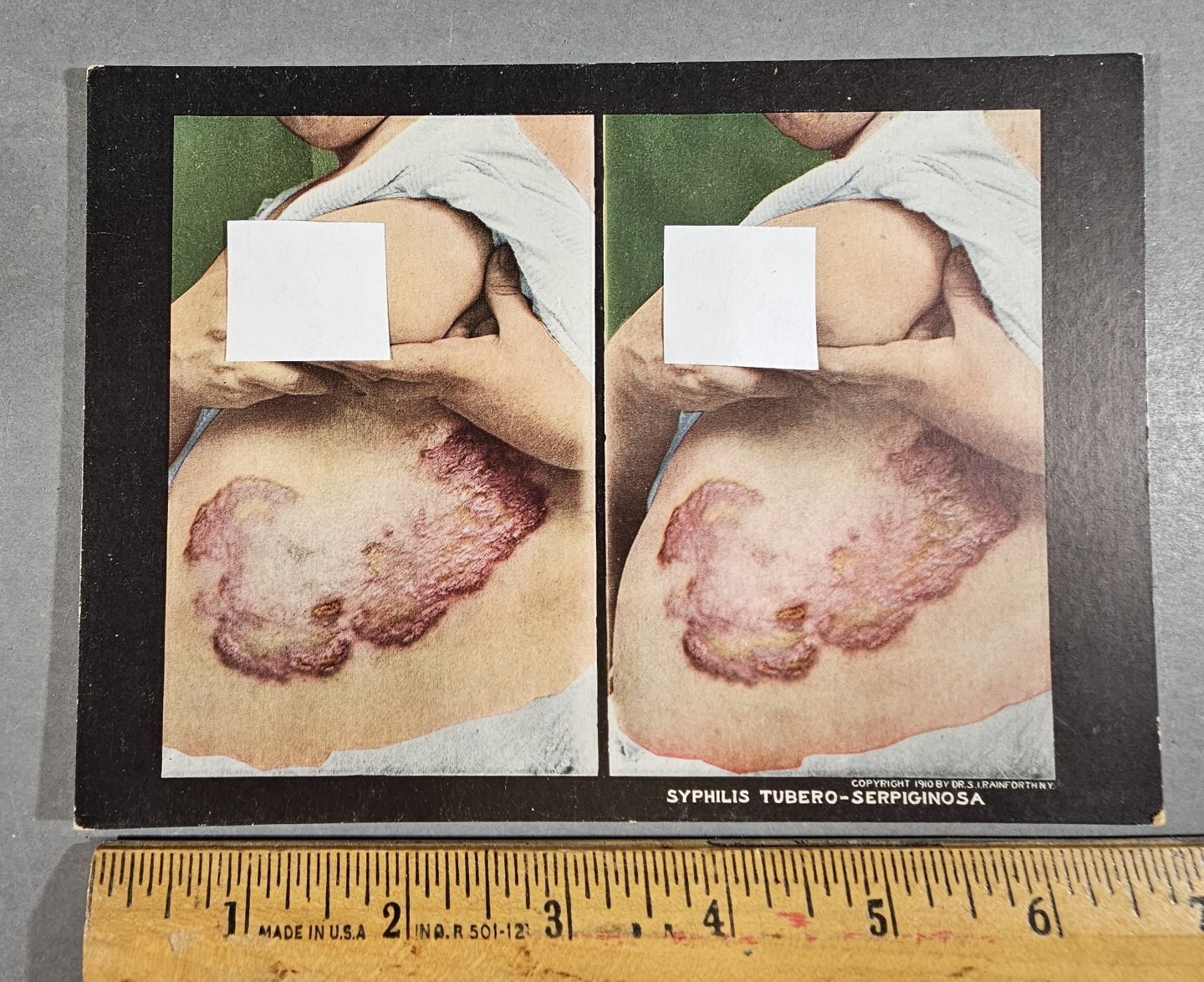 1910 MEDICAL SKIN DISEASE STEREOVIEW #105 SYPHILIS TUBERO-SERPIGINOSA, RAINFORTH
