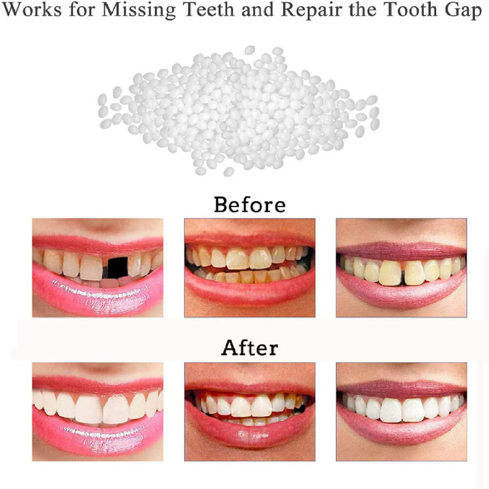 Tooth Repair Kit - Temporary Teeth Replacement Kit for Missing & Broken Teeth US