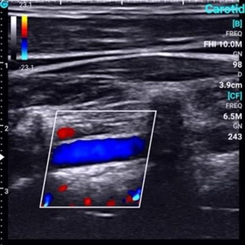 Supper Small Chison SonoEye P1 Linear Array for android Color Doppler Vascular