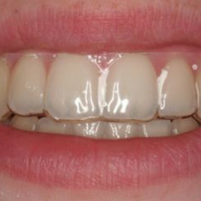 Temporary Replacement (2) teeth in Clear Retainer for Upper OR Lower, 3/way ship