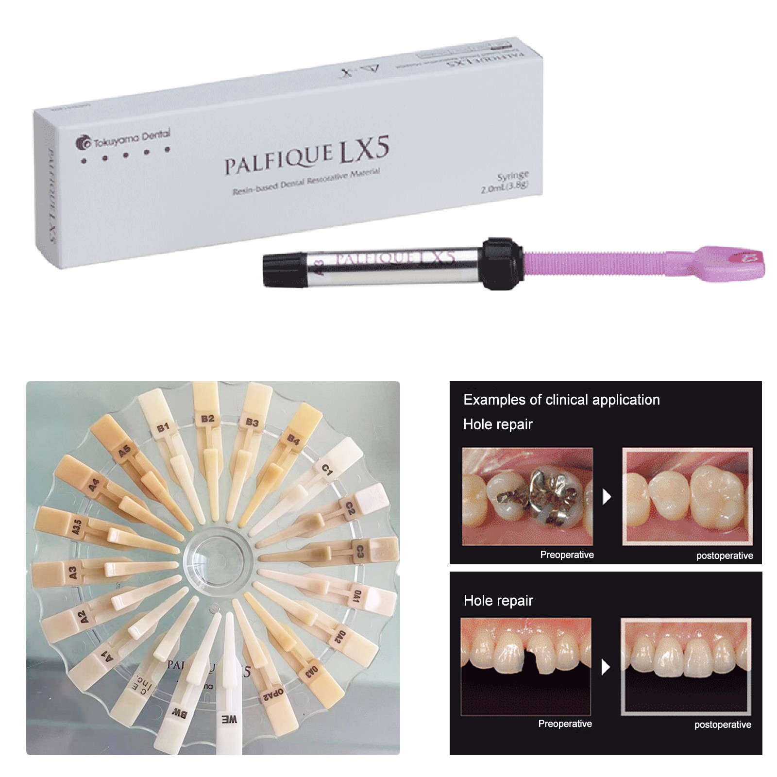 Palfique Tokuyama LX5/Dentex Universal Resin Based Dental Restorative Composite