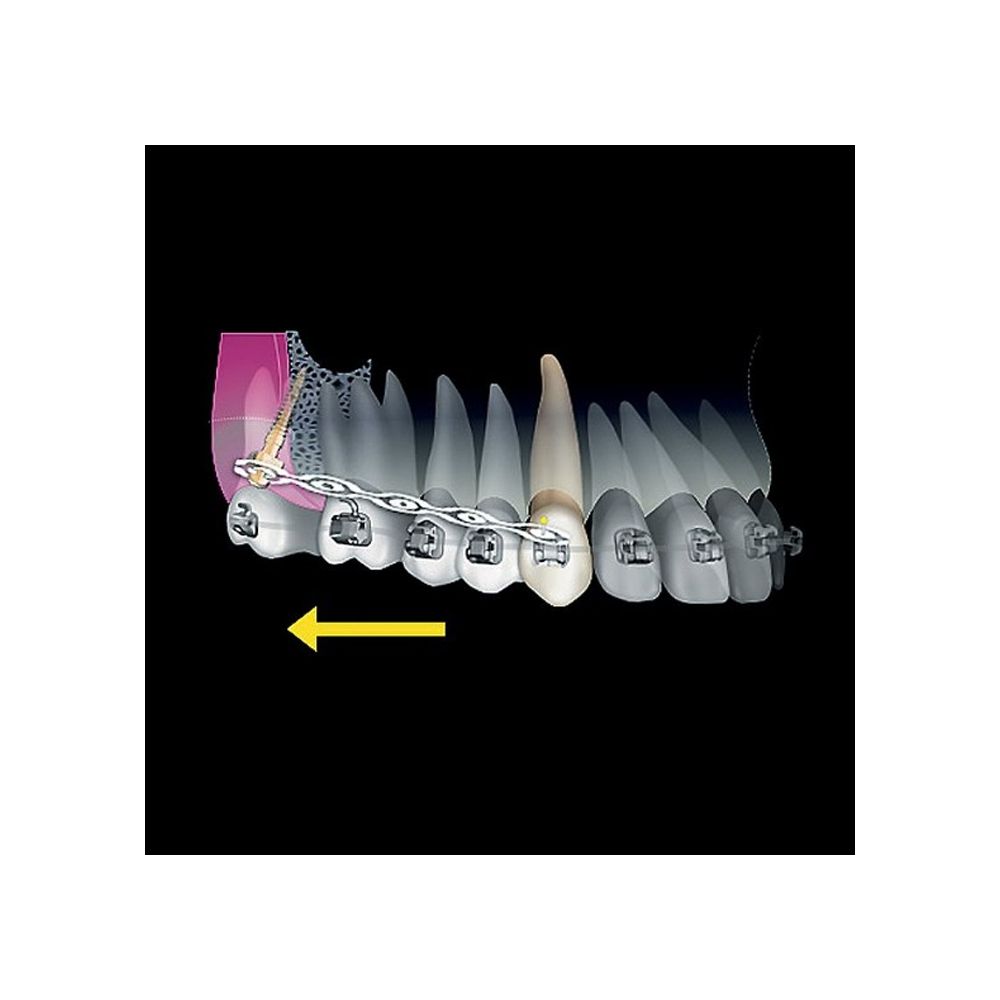 Dental Titanium Orthodontic B0ne Mini Screw Zygomatic TAD IZC L17mm Ø2mm