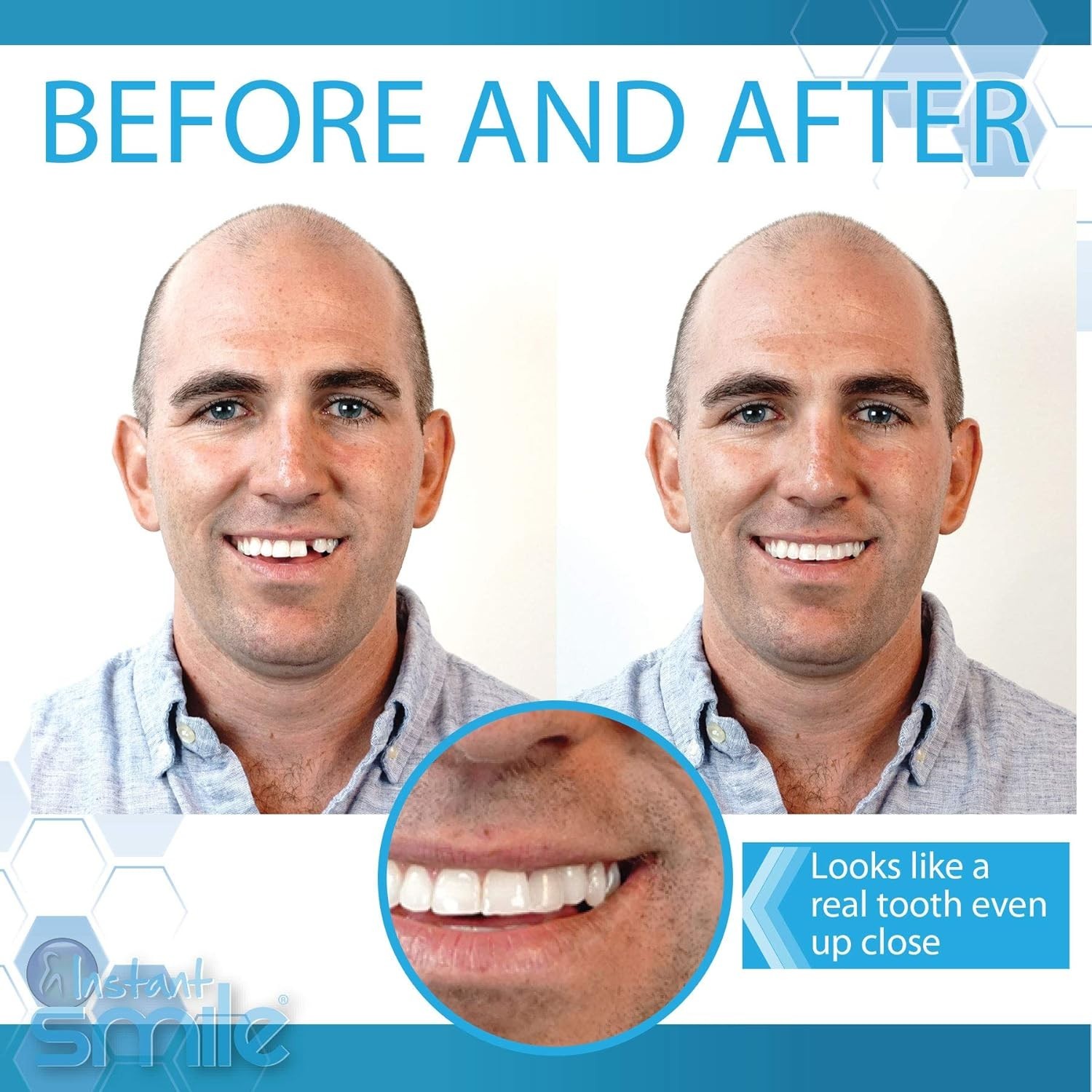 Complete Your Smile Temporary Tooth Replacement Kit - Replace a Missing Tooth...