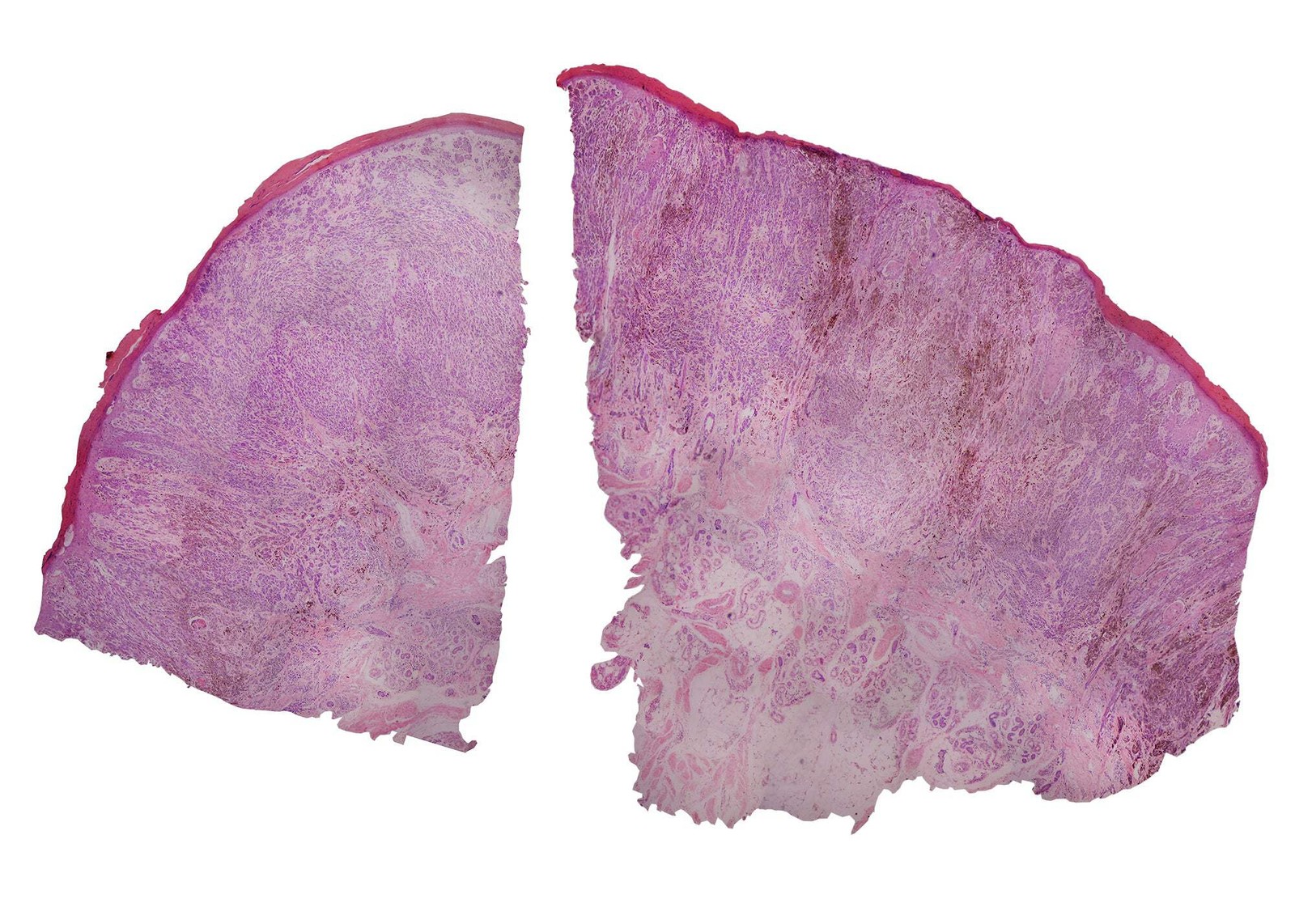 Melanoma (Human); Cross Section; H&E Stain