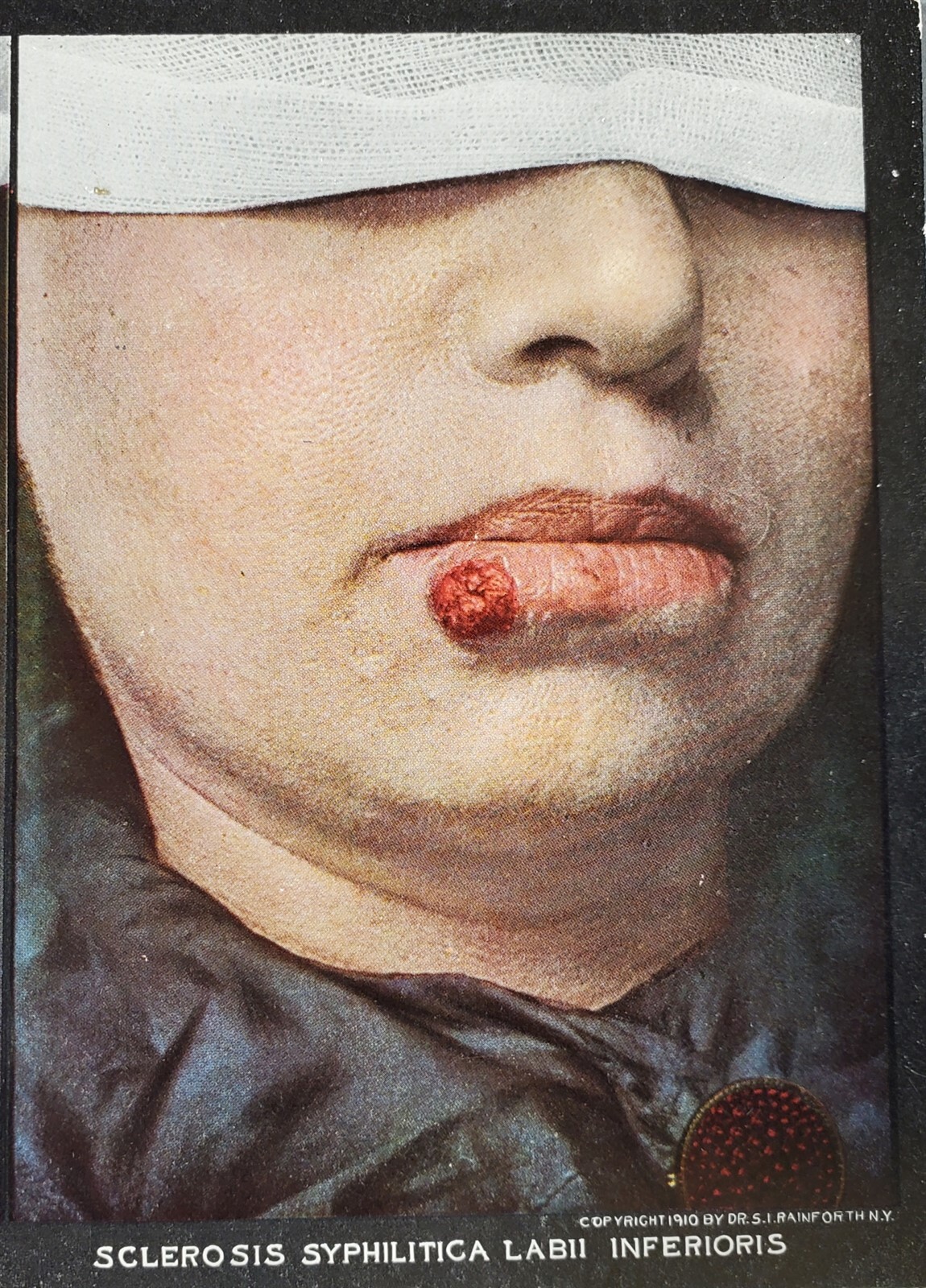 1910 MEDICAL SKIN DISEASE STEREOVIEW CARD SCLEROSIS SYPHILITICA #86, RAINFORTH